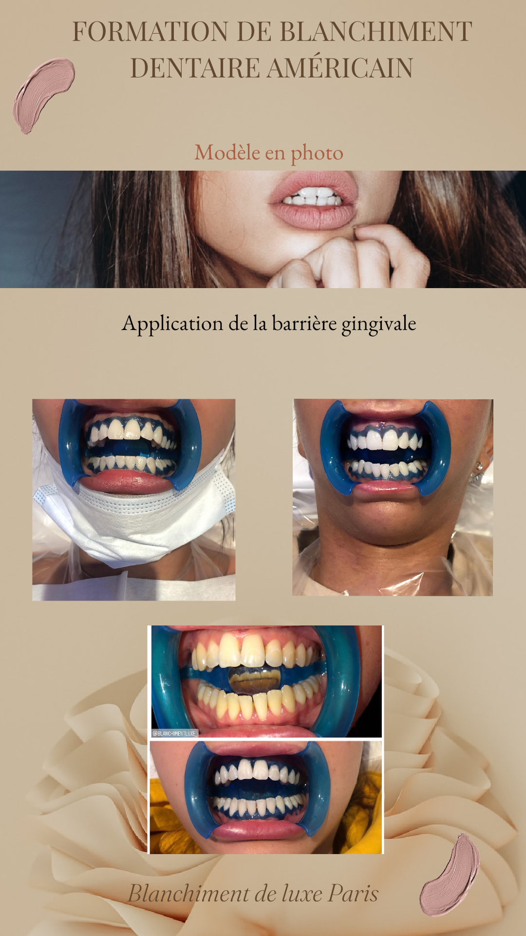 Formation blanchiment dentaire + Certification et Kit de démarrage